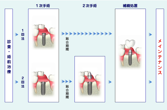 インプラント手順