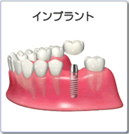 インプラント